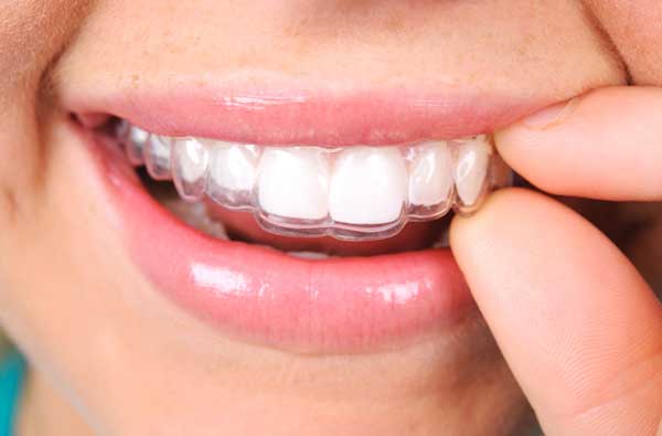 Close up of woman using clear aligner tray over teeth