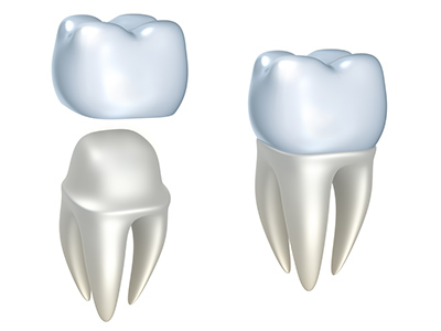 Image of a dental crown at Myers Park Dental Partners in Charlotte, NC.