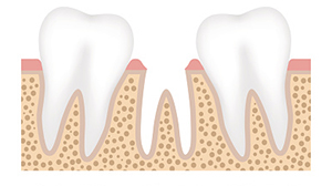 Diagram rendering of row of teeth with tooth loss