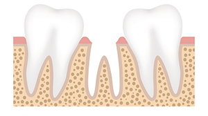 Diagram rendering of row of teeth with tooth loss