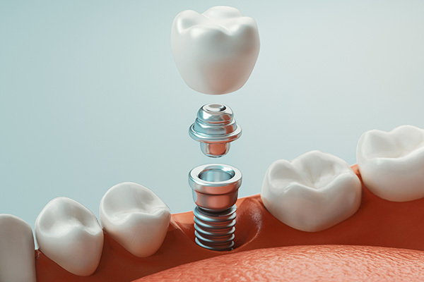 Image of a single tooth dental implant, at Myers Park Dental Partners in Charlotte, NC.