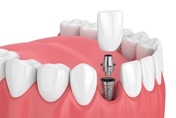 Image of a dental implant at Myers Park Dental Partners in Charlotte, NC.