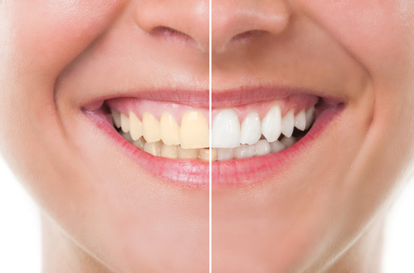 Before and after photo of teeth whitening treatment at Myers Park Dental Partners in Charlotte, NC