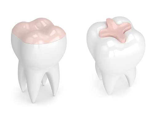 Diagram of inlay and onlay at Myers Park Dental Partners in Charlotte, NC