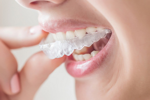 Close up of a woman removing her clear aligner